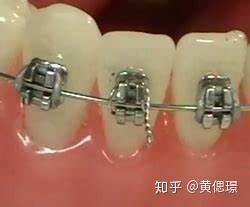 2021年春节期间牙套er应急自救指南