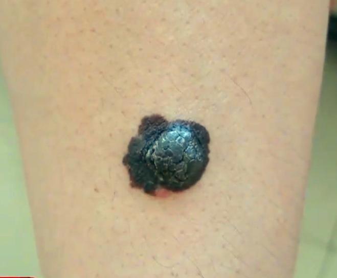 你身上的痣是什么,你身上的痣代表什么