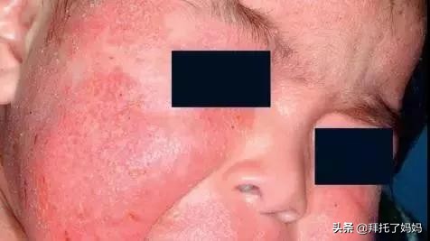 预防痱子小窍门,热痱和痱子的区别