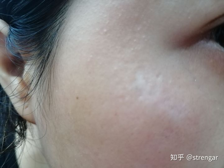 陈金西细胞种植可靠吗,陈金西细胞再生技术疤痕修复