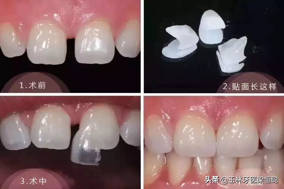 门牙缺损瓷贴面,牙缝大牙齿瓷贴面步骤全过程