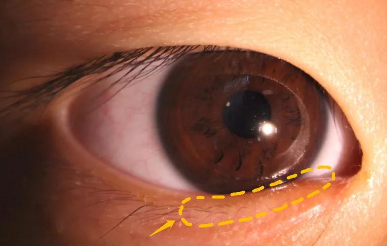 广东5岁男童经常莫名流泪，一查发现眼睑内翻、倒睫，要手术