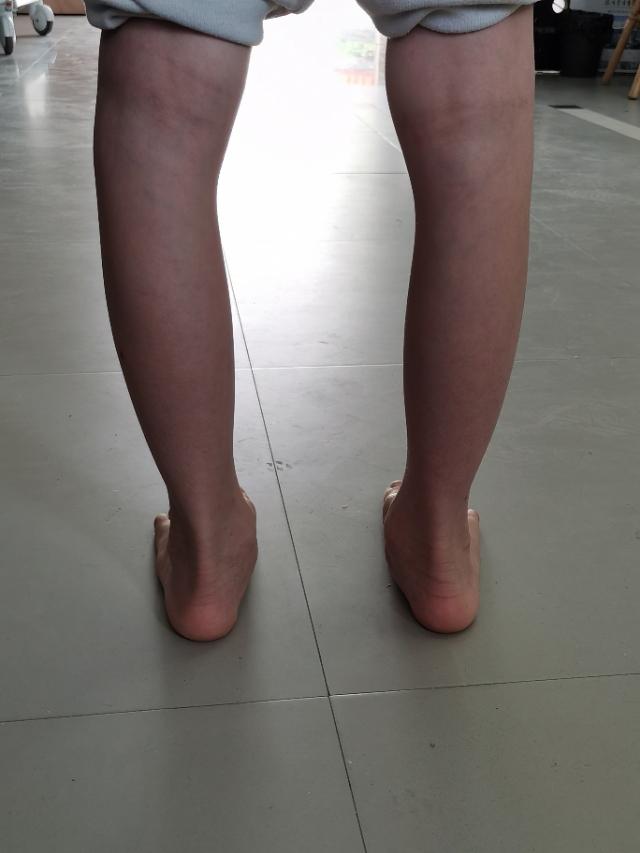 预防足外翻的绑带,儿童买鞋预防足外翻