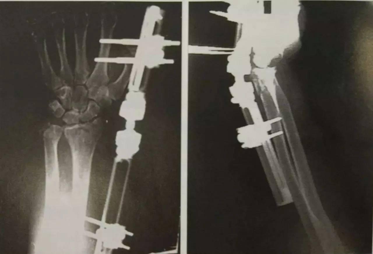 膝关节脱位，可以采取闭合复位，一般需要对关节内的血肿进行清除