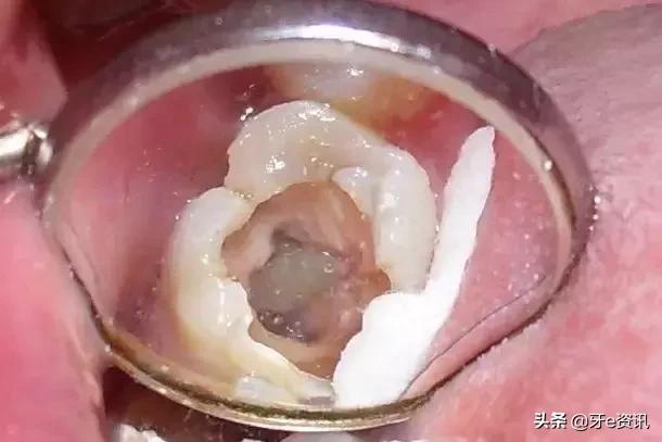 口腔三大疾病是哪几种,口腔里的结石有哪几种