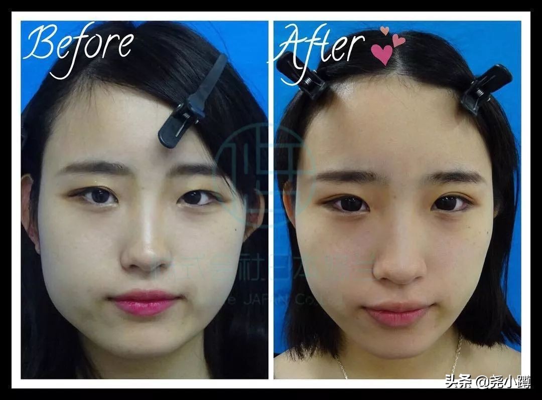 瘦脸针的科普,瘦脸针知识普及