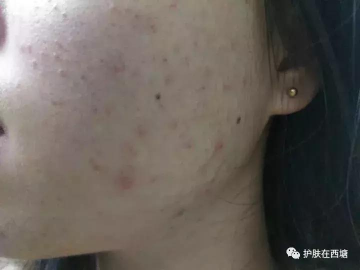 为什么额头上的痘痘反反复复,十几年的痘痘反反复复怎么办