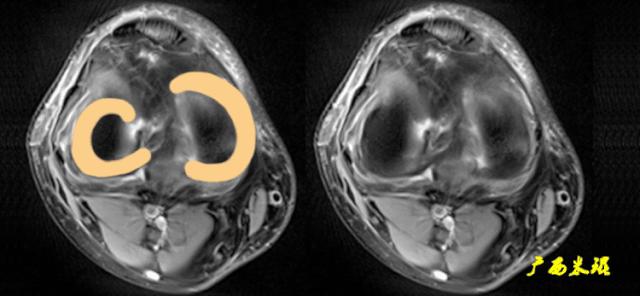 交叉韧带损伤的mr表现,后交叉韧带损伤的诊断实验