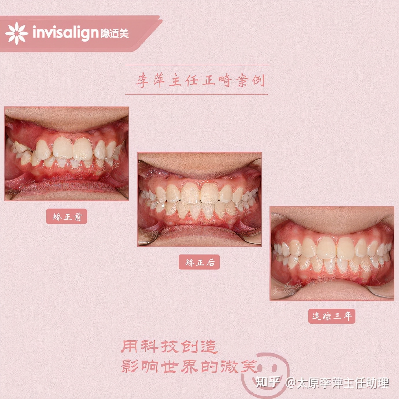 太原市牙齿正畸,太原市口腔正畸