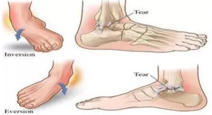 脚扭时听到嘎嘣一声响,脚扭了嘎吱一声