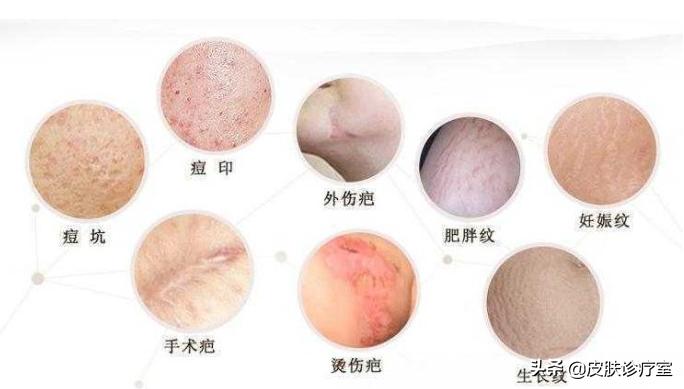 怎么祛疤无成本,怎么祛疤呢