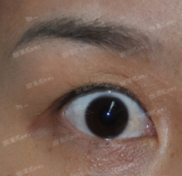 双眼皮手术后眼神凶狠是什么原因,双眼皮手术后显凶