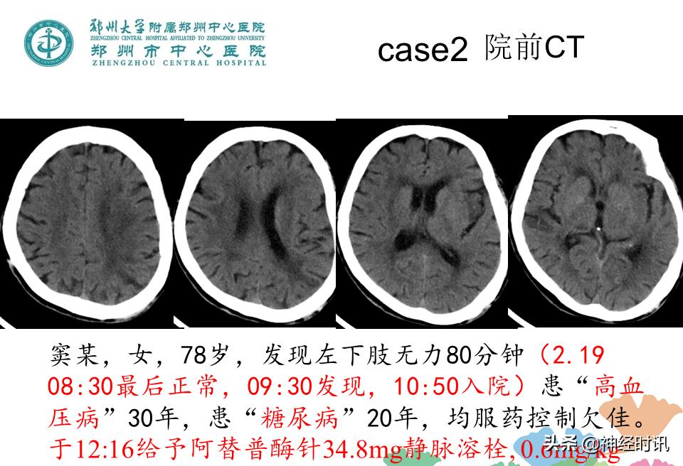 静脉溶栓怎么引起的,静脉相关并发症的预防及处理
