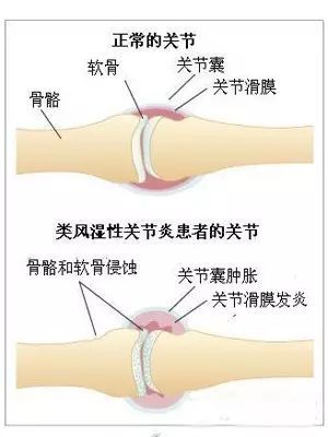 痹症用针灸治疗是缓解还是根治,痹症针灸哪些穴位