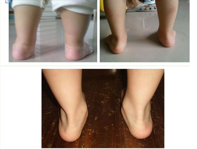 3岁足外翻到底要不要干预,儿童足外翻要早干预吗