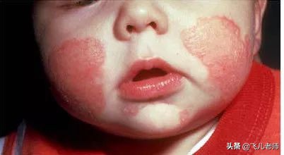 孩子湿疹的原因及处理方法,孩子湿疹老不好是怎么回事