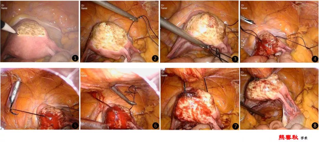 女子子宫脱垂如何保健恢复,省人民医院妇科治疗子宫脱垂