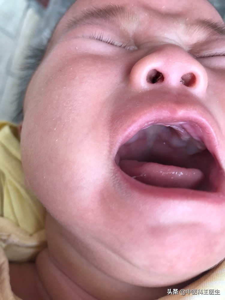 新生儿鹅口疮和奶块的区别,鹅口疮白屑与残留奶块如何鉴别