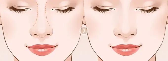 导致鼻子大的原因,什么行为导致鼻子大鼻翼宽