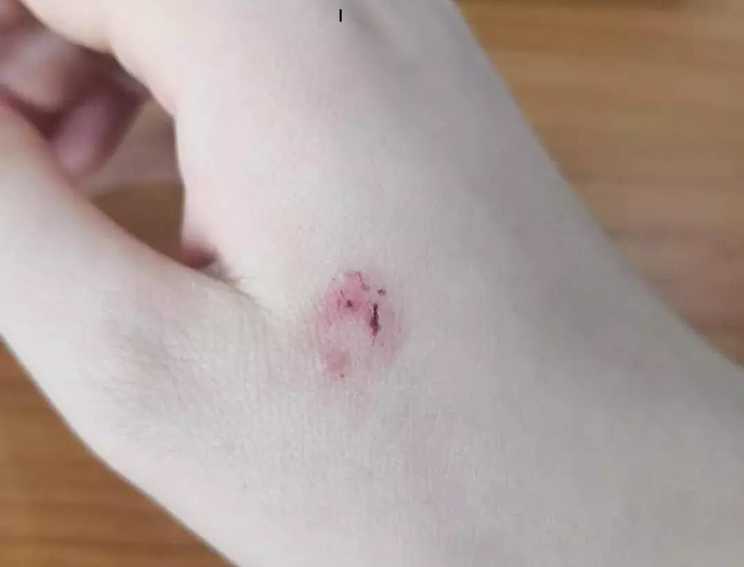 被狗咬了疫苗要打哪里,被狂犬狗咬了怎么办