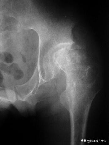 骨折的影像学检查及各自的优势,骨折的影像学愈合标准