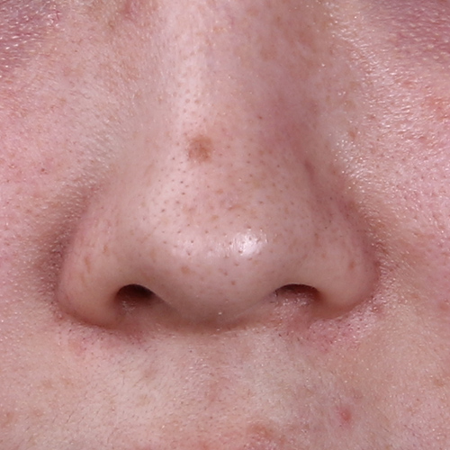 为什么鼻翼两侧泛红起皮,为什么鼻翼两侧干起皮