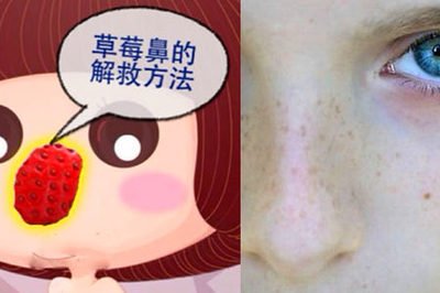 草莓鼻和无草莓鼻,最有效去除草莓鼻的方法