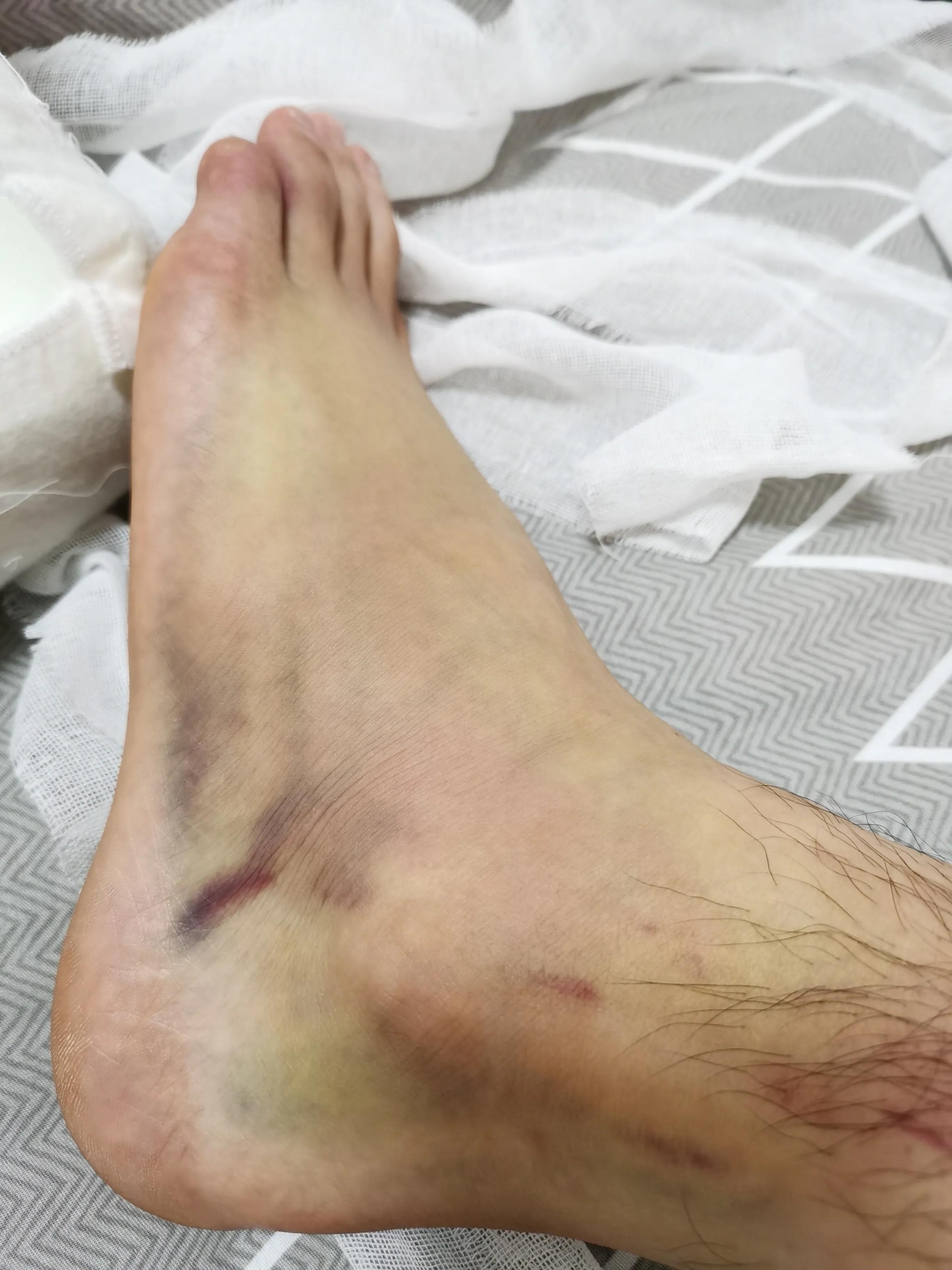 第五跖骨粉碎性骨折多久后能走路,第五跖骨基底骨折100天了走路肿