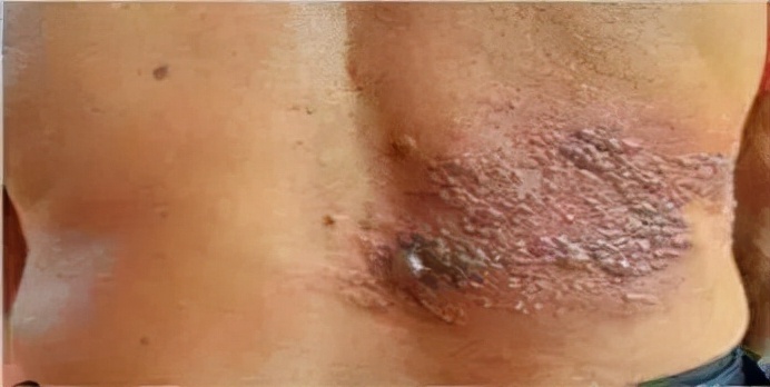 水痘好了下个月可以移植了吗,水痘愈合后还有痘吗