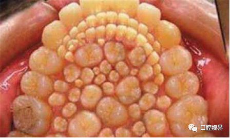 老年人拔牙后注意事项要牢记,糖尿病拔牙后注意事项与禁忌