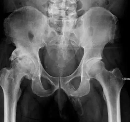 男子生殖器自燃的新闻,男性生殖器着火