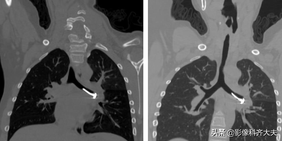 ct能查出气管微小异物嘛,气管异物ct怎么做