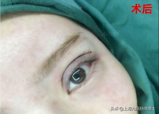 刚做完双眼皮闭眼总翻白眼正常吗,割了双眼皮为啥眼睛老流泪