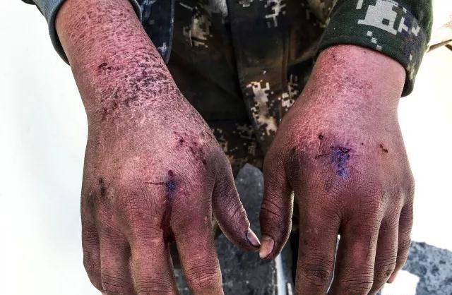 液氮冻伤是什么感觉,液氮冻伤的十大案例