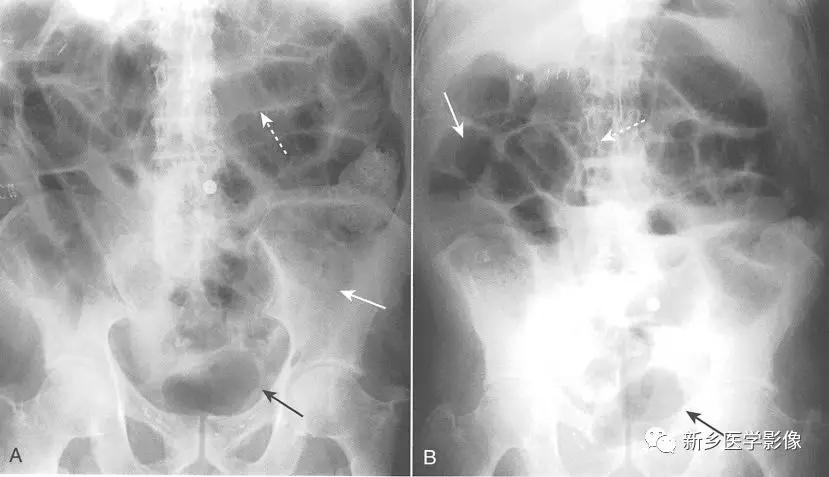 辨识肠梗阻,肠梗阻死亡前兆
