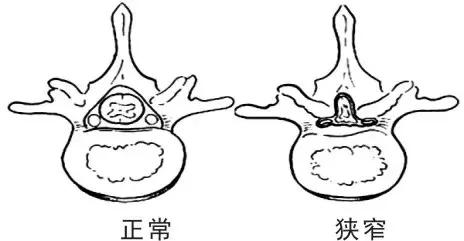 椎间盘突出和椎管狭窄症状的区别,腰椎管狭窄症的症状