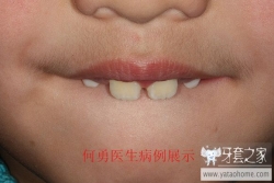 正畸医生如何指定方案的,正畸医生怎么说