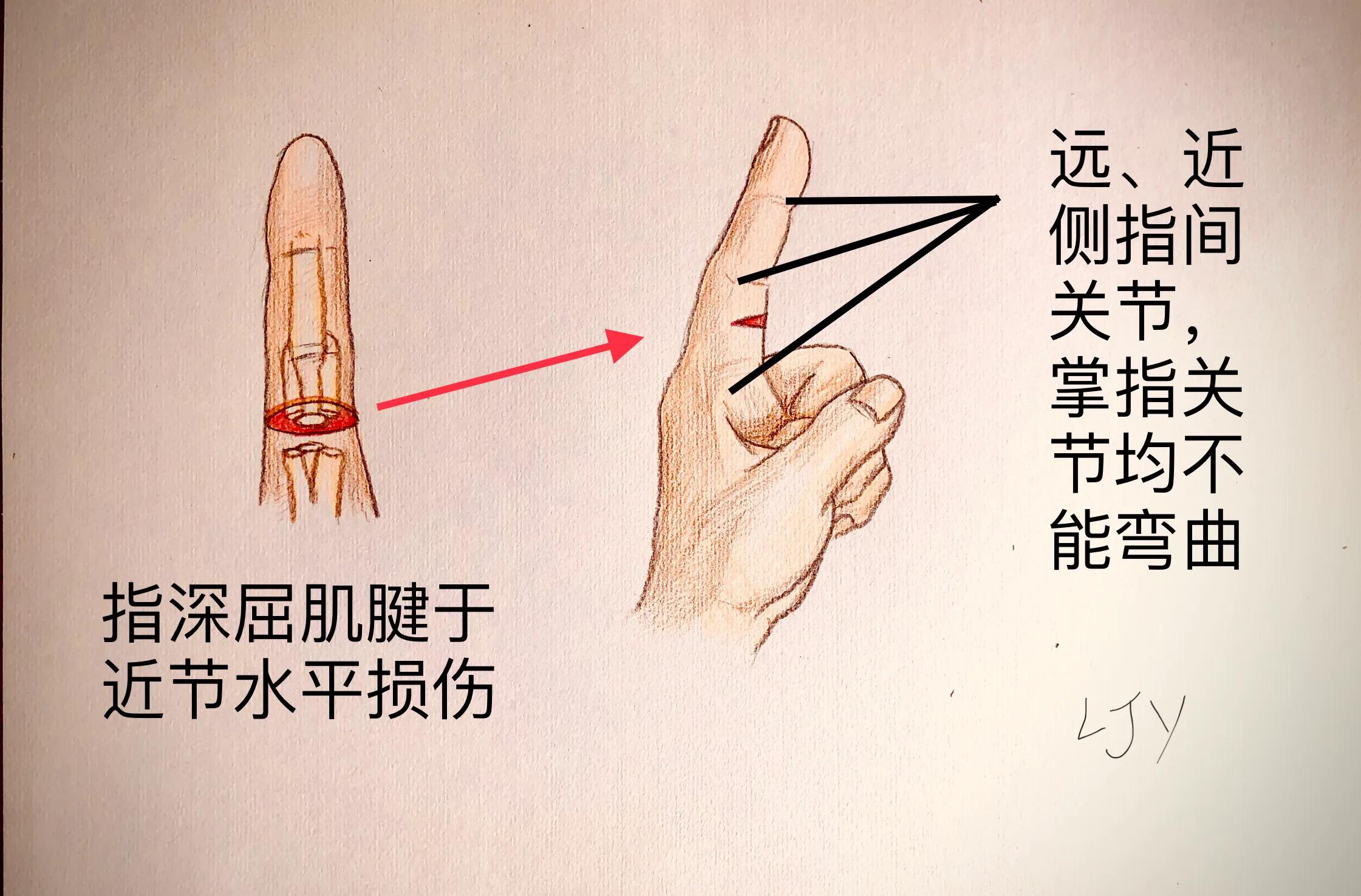 手被割伤如何处理,手被割伤了较深要如何处理