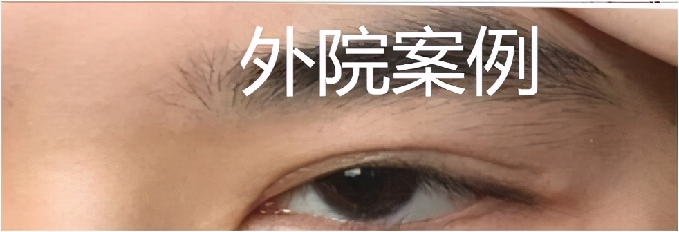 自己的双眼皮太深显老怎么修复,做的双眼皮一笑有皱纹怎么修复