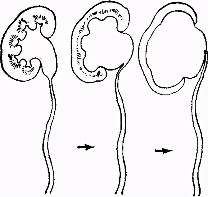 严重肾积水可以保守治疗吗,严重肾积水需要治疗吗