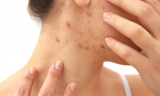 白醋加盐和水祛痘有效果吗,白醋洗脸祛痘的正确方法