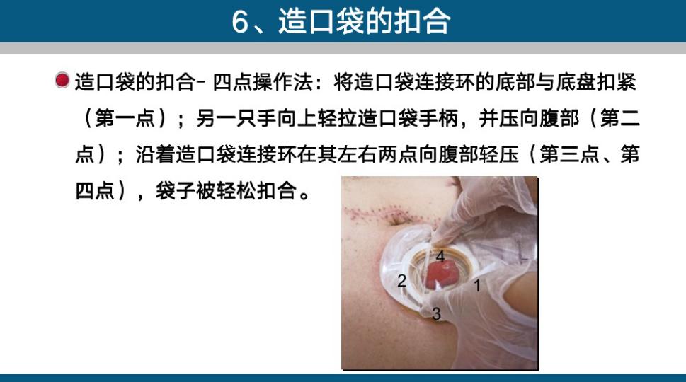 造口手术后多久复查一次,造口复查检查什么