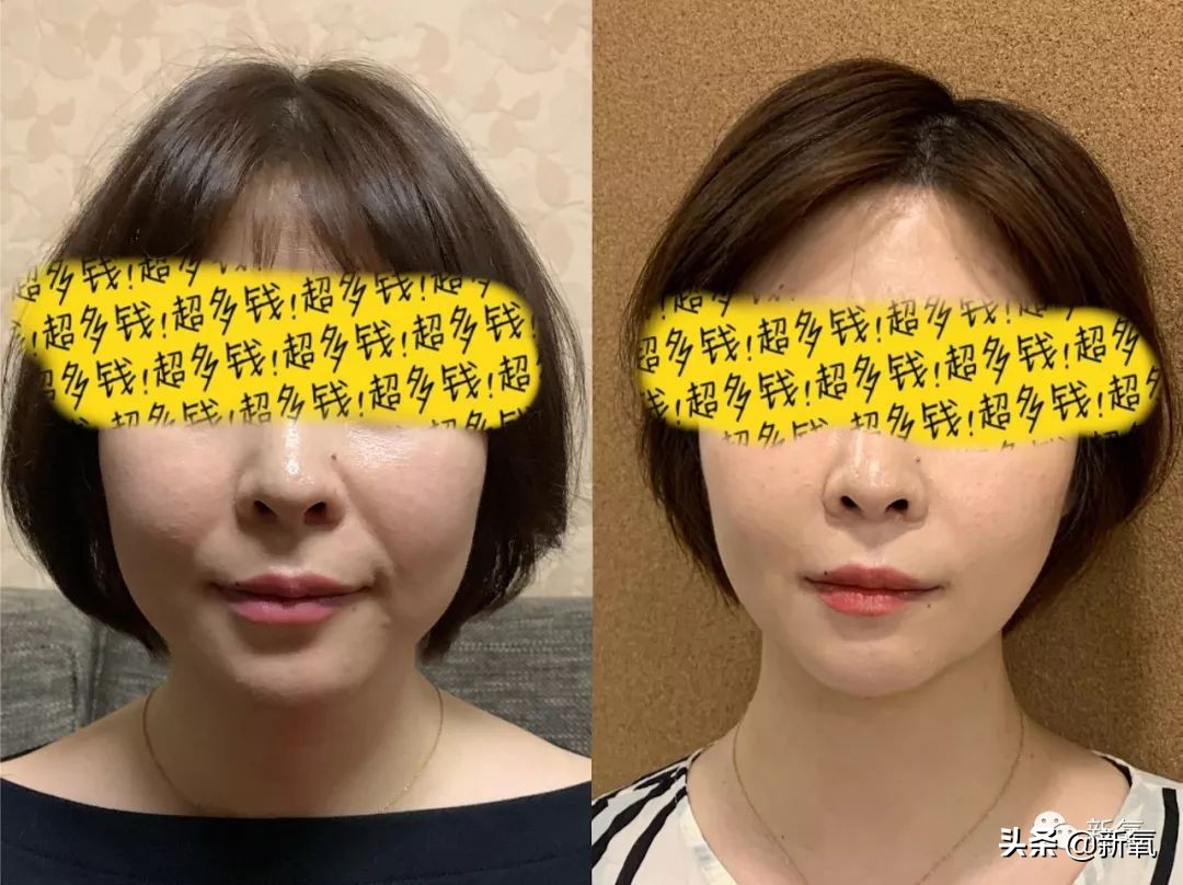 迷死氧亲身体验，我在日本吸掉了一桶脂肪和半张脸