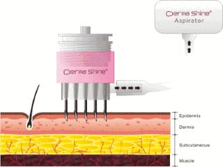 水光针究竟靠不靠谱,水光针究竟怎么选