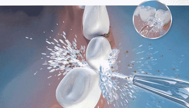 洗完牙后牙酸正常吗,洗完牙吃东西牙齿酸怎么回事