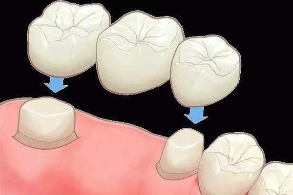 刘涛花了多少钱做牙齿,刘涛整牙花了多少钱