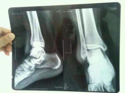 脚踝撕脱性骨折三个月一瘸一拐,脚踝撕脱性骨折骨头变大