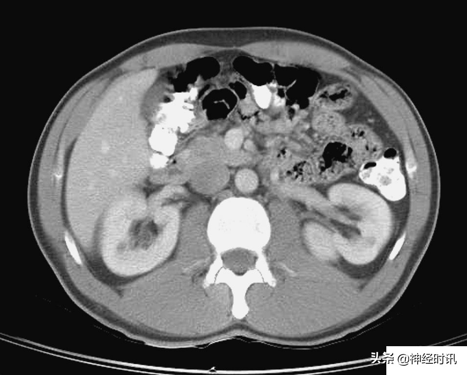 肾脏输尿管膀胱前列腺结构,肾输尿管膀胱解剖示意图