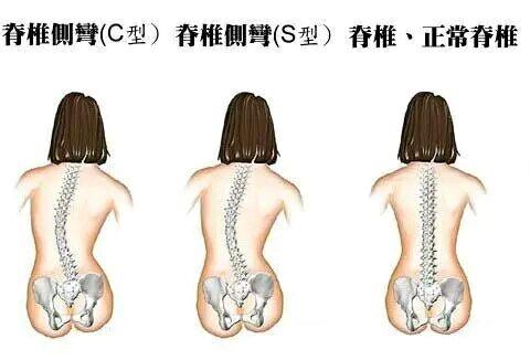 孩子发现脊柱侧弯该怎么办,十七岁女孩发现脊柱侧弯怎么办