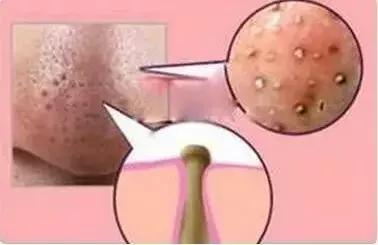 闭口粉刺痘痘黑头白头的区别,开口粉刺和闭口怎么区分